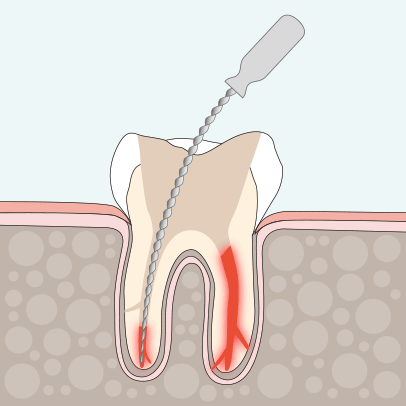 Endodontie Wurzelkanalbehandlung